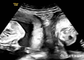 Woman with rare double uterus gives birth to twins