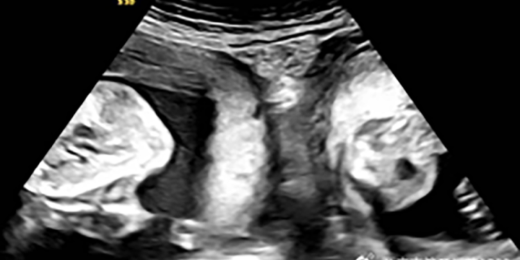 Woman with rare double uterus gives birth to twins